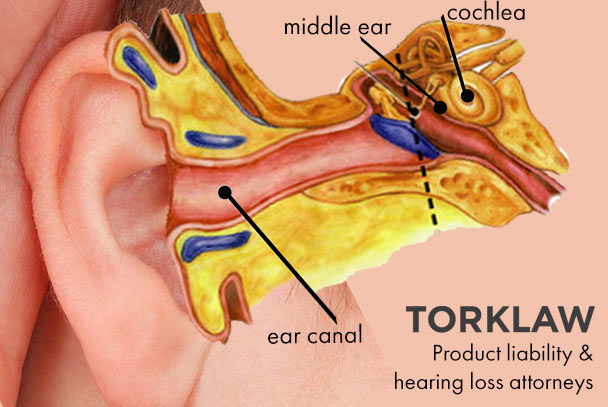 hearing loss - product liability