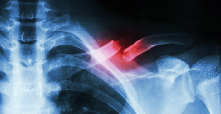 broken bone xray