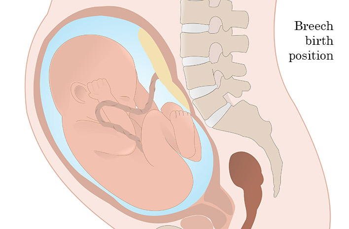 Breech birth may result in brachial plexus injury