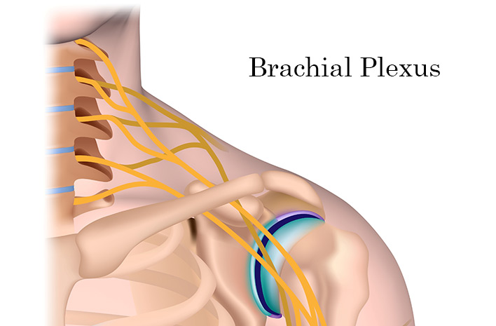 Injury to brachial plexus can happen at birth