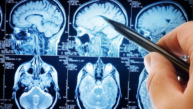 traumatic brain injury
