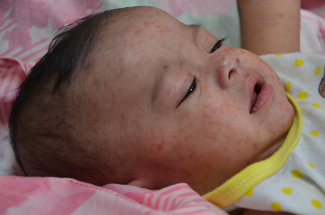 National Immunization Awareness Month - measles