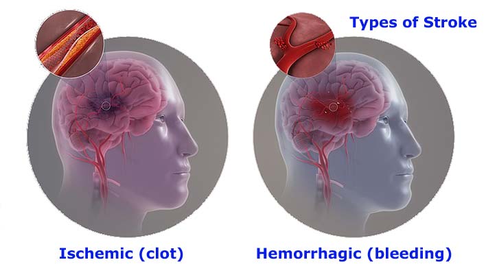 stroke types