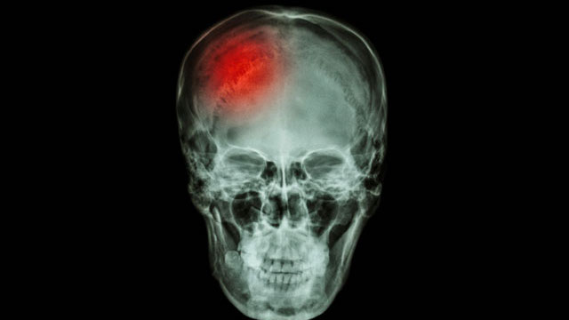 concussion