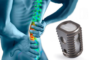 medtronic-infuse-lawsuit