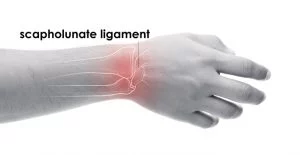 Scapholunate Ligament Tear - Torn Ligament in the Wrist | TorkLaw